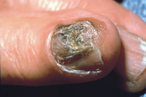 Acral Melanoma on Finger