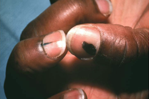 Acral Melanoma on Hand