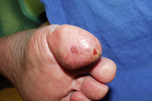 Acral Melanoma on Toe