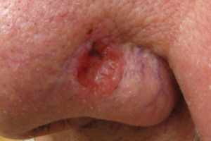 Basal Cell Carcinoma on Nose