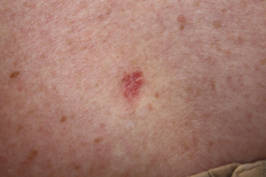 Basal Cell Carcinoma