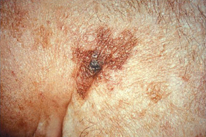 Lentigo Maligna Melanoma on Brow