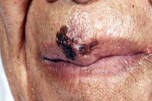 Lentigo Maligna Melanoma on Lip