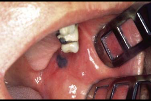 Mucosal Melanoma in Mouth