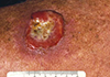 Nodular Melanoma