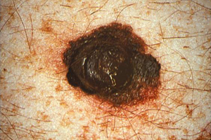 Nodular Melanoma