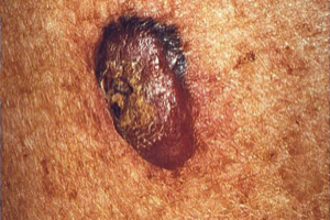 Nodular Melanoma