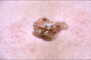 Squamous Cell Carcinoma