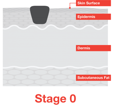 Stage 0 Melanoma Skin Cancer In Situ