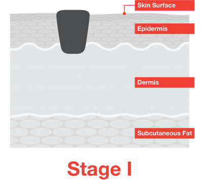 Stage I Melanoma Skin Cancer