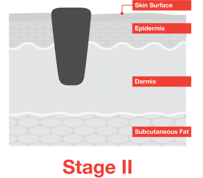 Stage II Melanoma Skin Cancer