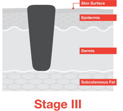 Stage III Melanoma Skin Cancer