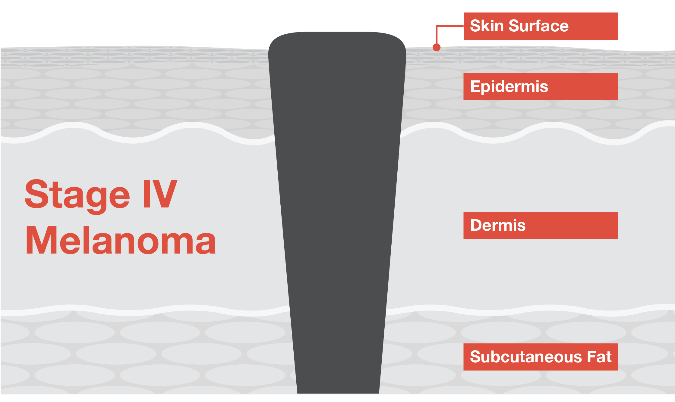 Stage IV Melanoma Illustration