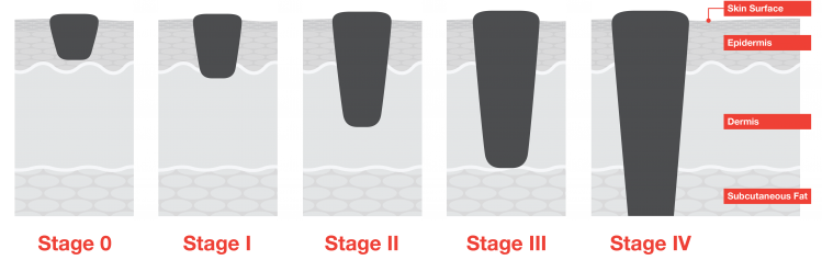 Stages of Melanoma