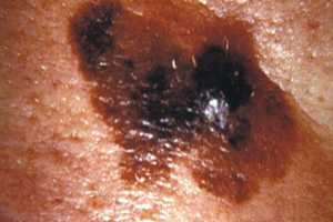 Superficial Spreading Melanoma