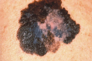 Superficial Spreading Melanoma