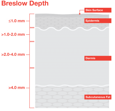 Understanding Melanoma Skin Cancer Breslow Depth