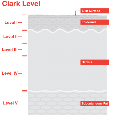 Understanding Melanoma Skin Cancer Clark Level