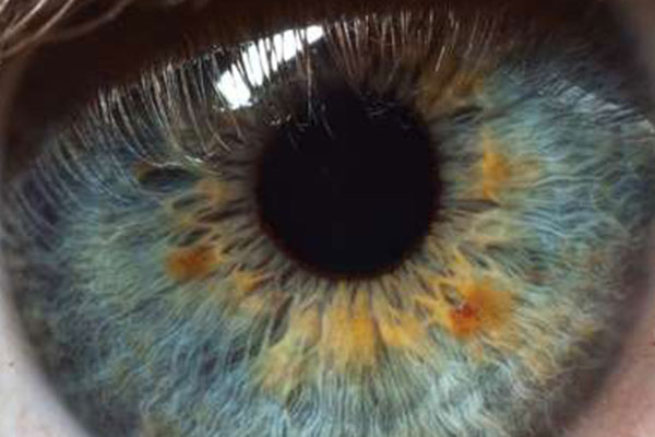 Uveal Melanoma Research Advances