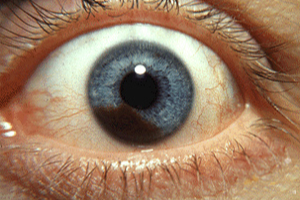 Uveal Melanoma