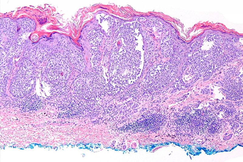 NeoAdjuvant.Melanoma.Treatment