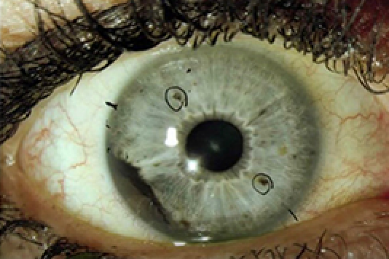 Uveal Melanoma3